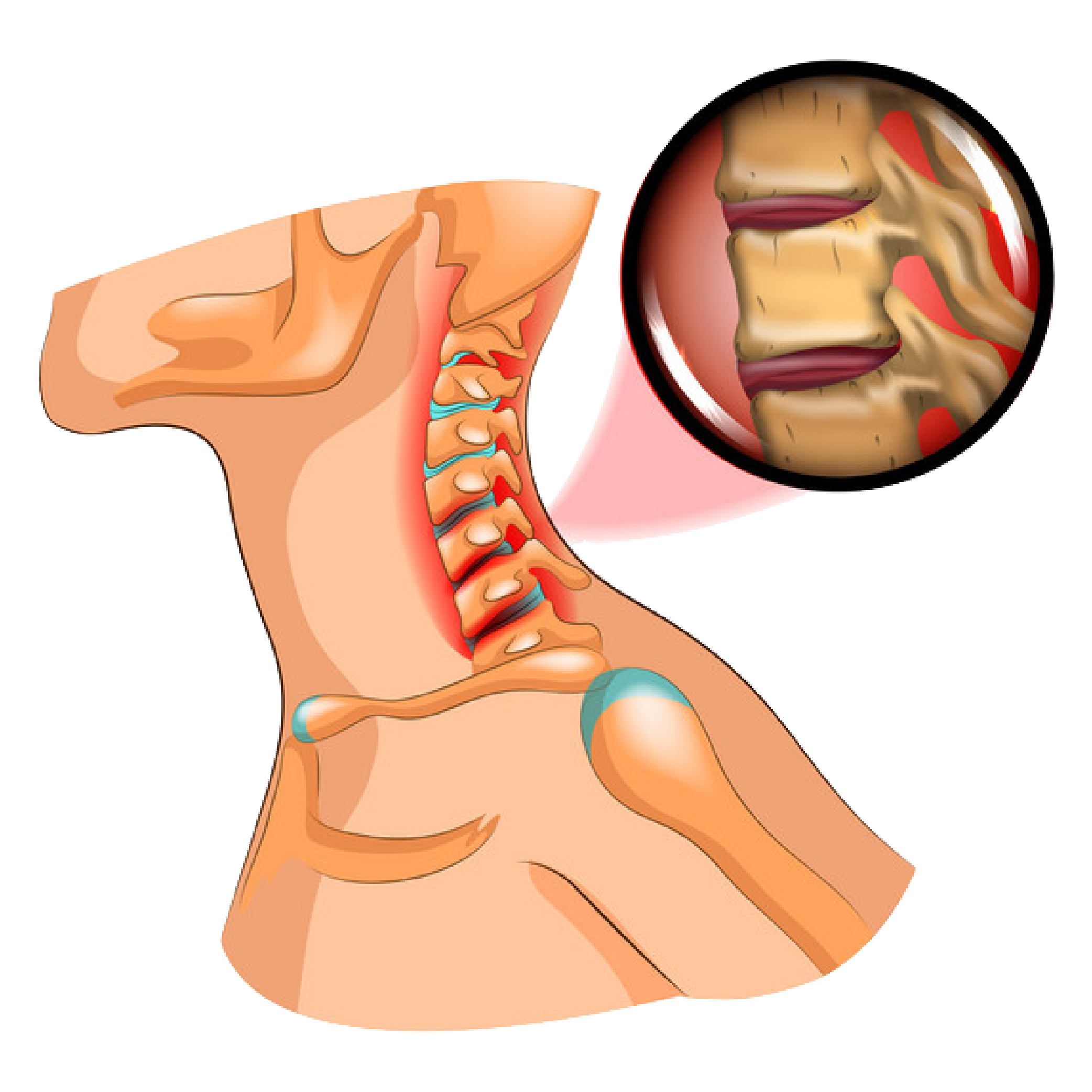 Cervical Spondylosis